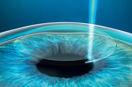 全飞秒激光手术